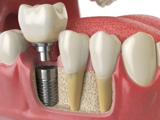 implant implant