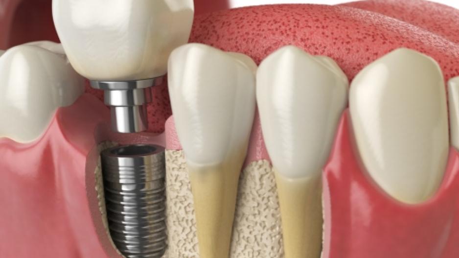 implant implant